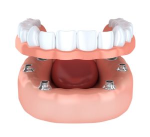 Denture Implants white teeth