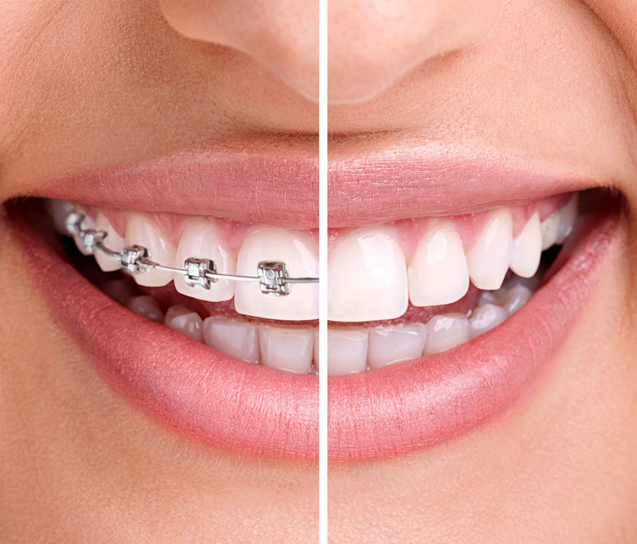 Things to keep in mind before undergoing an Aesthetic dentistry procedure braces