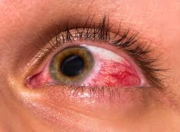 Eye Disease detection moorsfield