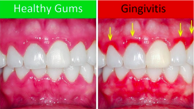 How to Have Healthy Gums