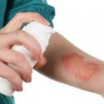 7 Tips for Taking Care of Burns at Home