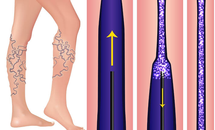 Sclerotherapy Treatments