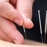 5 Conditions Acupuncture Can Help With