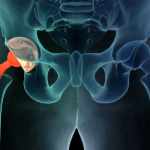 Benefits and Complications of Hip Resurfacing Surgery