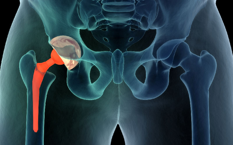 hip resurfacing surgery