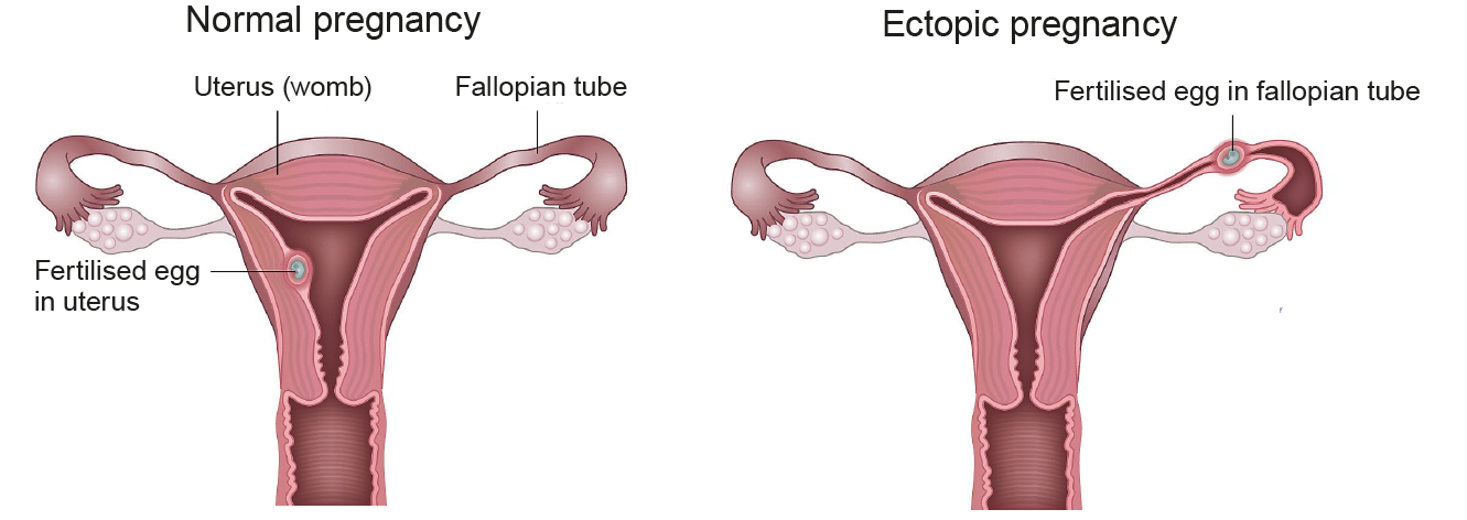 Ectopic Pregnancy Symptoms