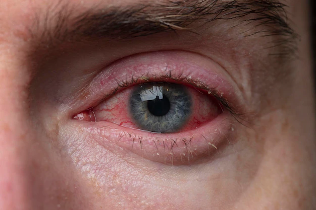 how long is pink eye contagious