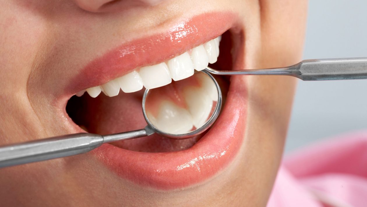 The Purpose of Tooth Fillings