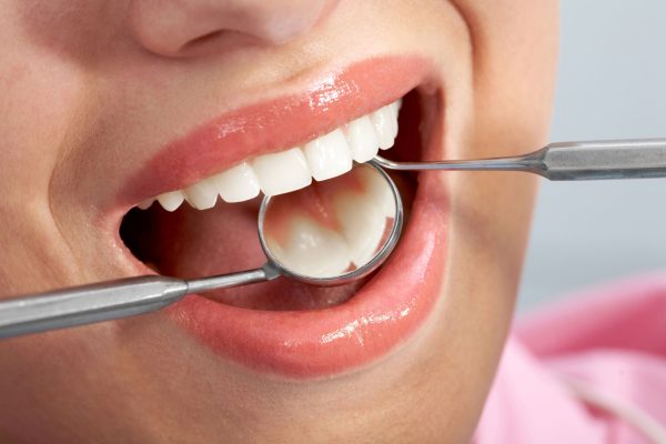 The Purpose of Tooth Fillings