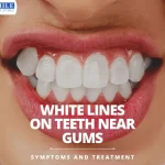 White-Lines-On-Teeth-Near-Gums